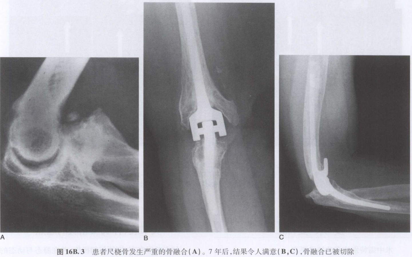 创新突破：尺桡骨融合技术迎来全新曙光